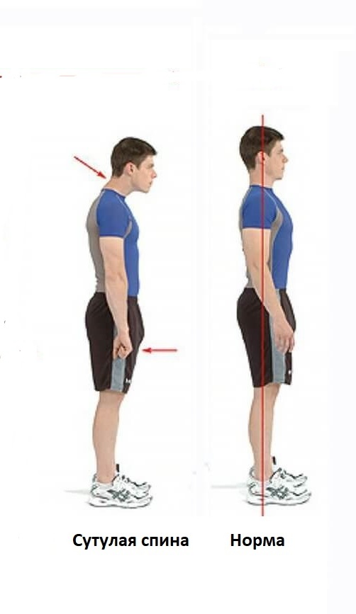 Нарушения и норма осанки