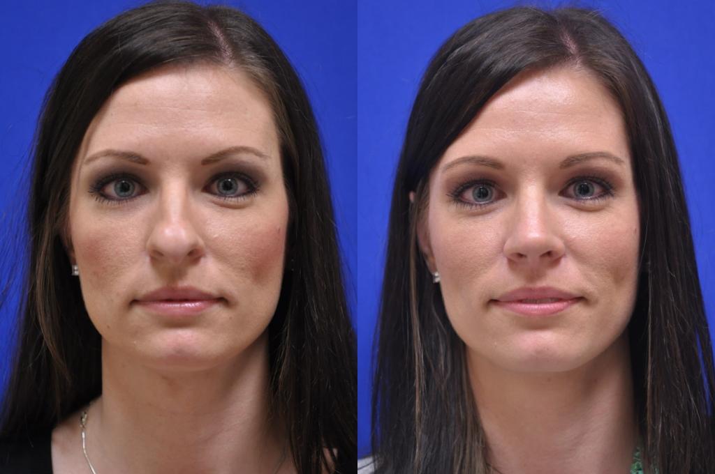 как выглядит лицо после коррекции асимметрии