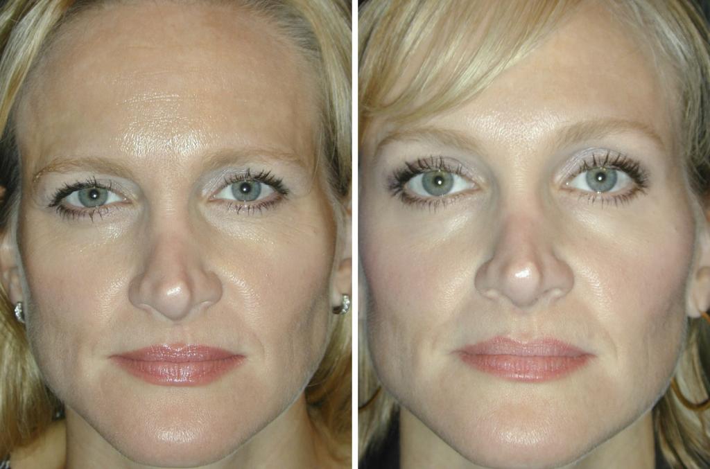 поднять брови ботоксом