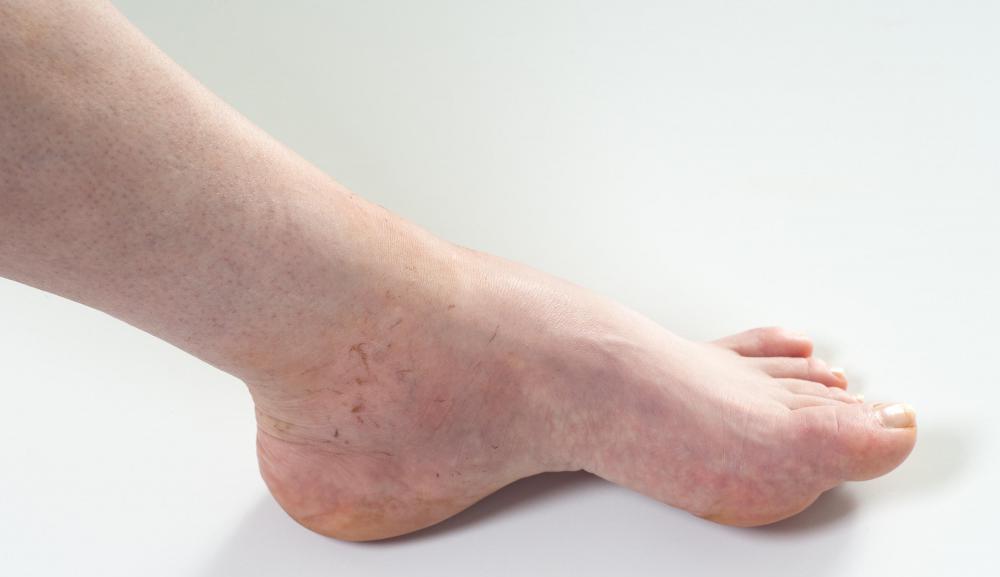 растяжение связок стопы