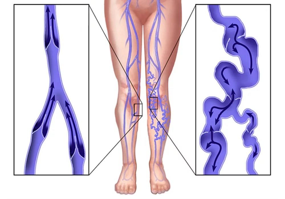 Нормальные и поврежденные вены
