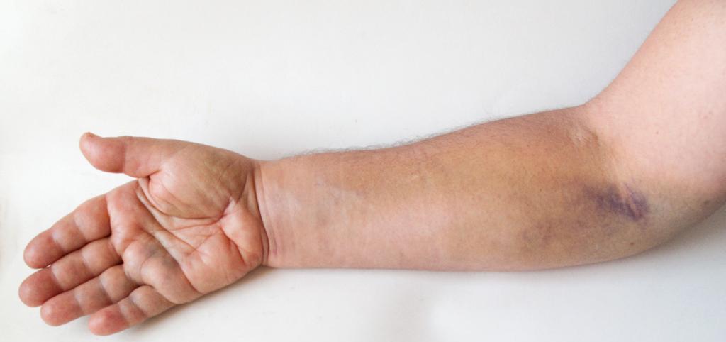 Первая помощь при растяжении связок