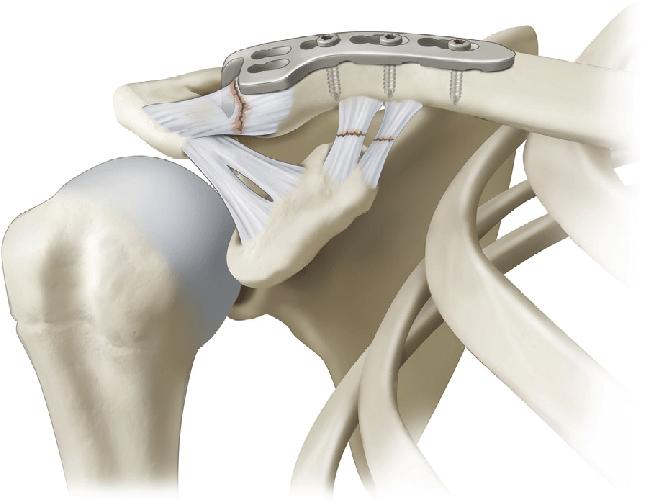 Перелом кости при вывихе.