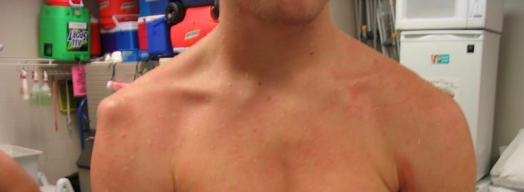 Вывих плечевого сустава (мужчина).