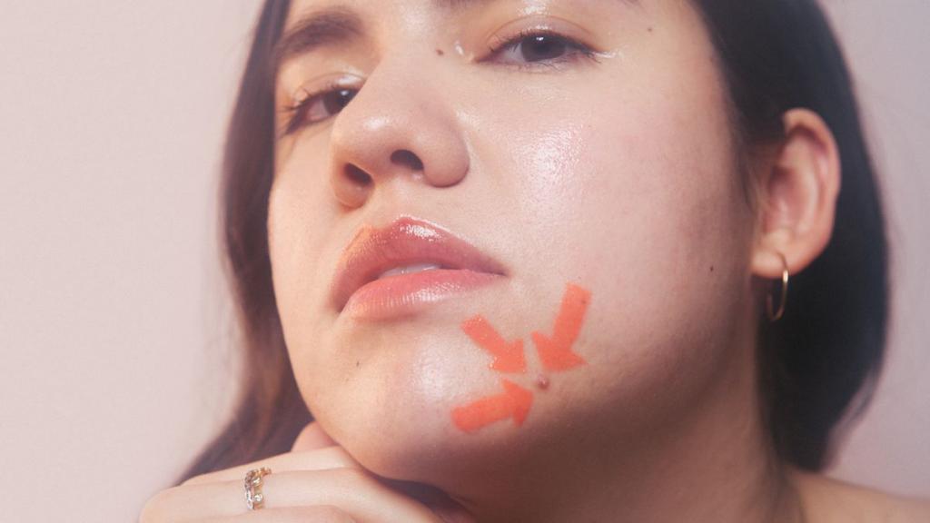 Как выглядит акне