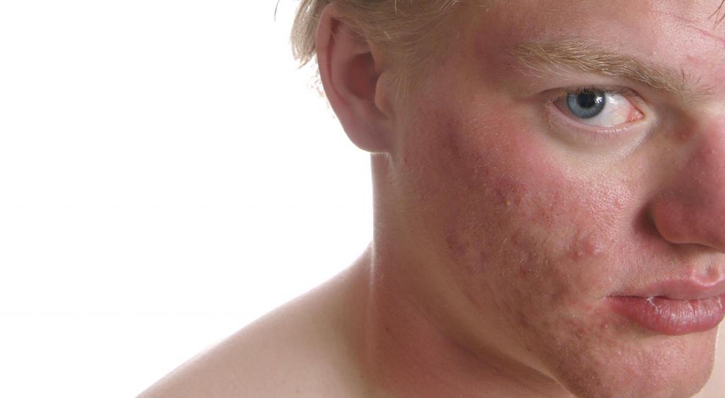 Средства от акне