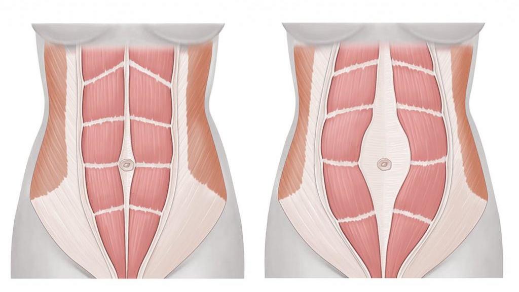 Диастаз живота